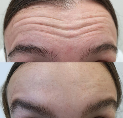 Forehead Before and After