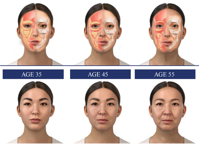Anatomica-Clinicall-changes-over-time A visual guide to the signs of facial aging. The image compares a woman's face at 35, 45, and 55, with diagrams revealing how changes in bone structure and the shifting of facial fat pads lead to the formation of wrinkles and loss of youthful volume, clearly connecting anatomical changes to appearance.